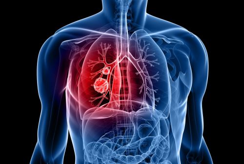 6003144 - human body shape with lung cancer