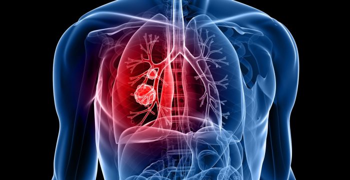 6003144 - human body shape with lung cancer