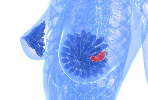 6530477 - breast cancer